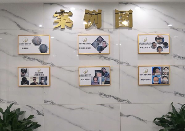 沈陽華美植發(fā)醫(yī)院案例圖
