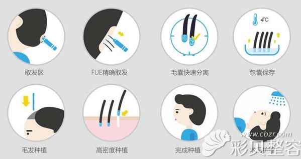 頭發(fā)種植流程