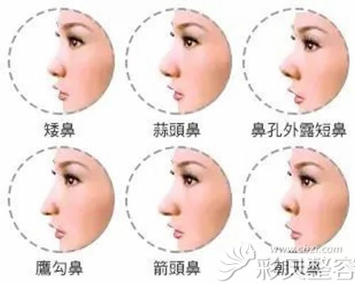 不美觀的鼻子效果圖 不美觀的鼻子效果圖