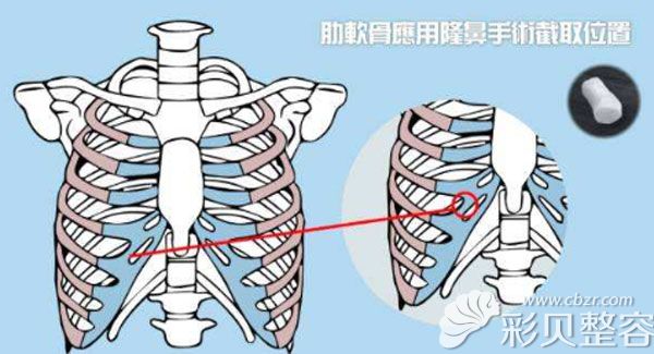 肋軟骨隆鼻的取骨位置 肋軟骨隆鼻的取骨位置