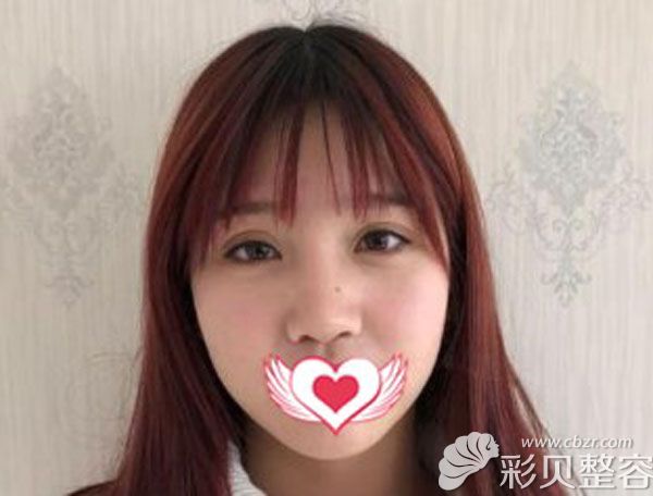 真皮脂肪瓣隆鼻墊2層可以嗎?來看我鼻尖吸收失敗的親身經歷