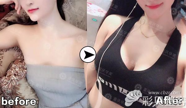 重慶華美曼托275cc水滴形假體隆胸 重慶華美曼托275cc水滴形假體隆胸