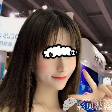 找廣州美萊田躍平做半肋骨術(shù)后恢復(fù)15天樣子