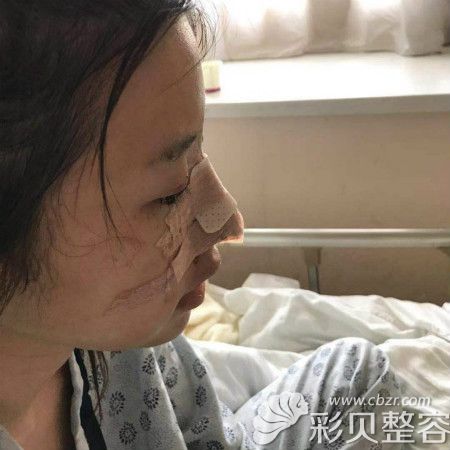 田躍平給我做半肋骨鼻術(shù)后第三天圖片