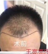 山西晉城植發(fā)醫(yī)院哪家好?他倆在芳華醫(yī)院種植的,看效果如何