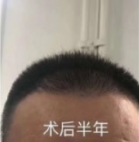 山西晉城植發(fā)醫(yī)院哪家好?他倆在芳華醫(yī)院種植的,看效果如何
