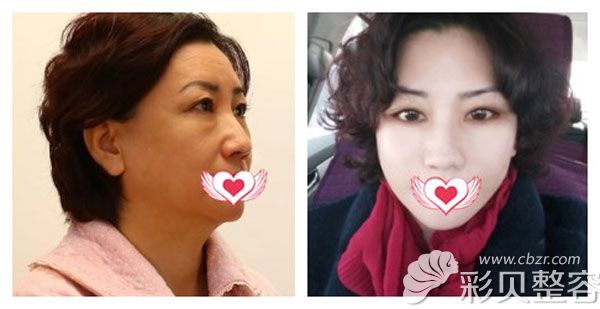 北京誰做拉皮手術(shù)好?華韓醫(yī)院柳民熙筋膜懸吊術(shù)案例來說話