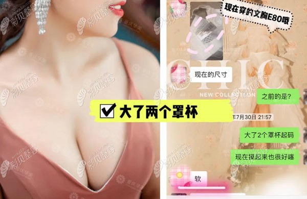 重慶華美假體隆胸效果怎么樣 重慶華美假體隆胸效果怎么樣