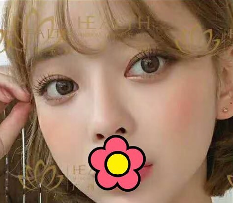 廣州禾麗眼綜合案例:腫泡眼的我做了小平行7mm雙眼皮后,絕了
