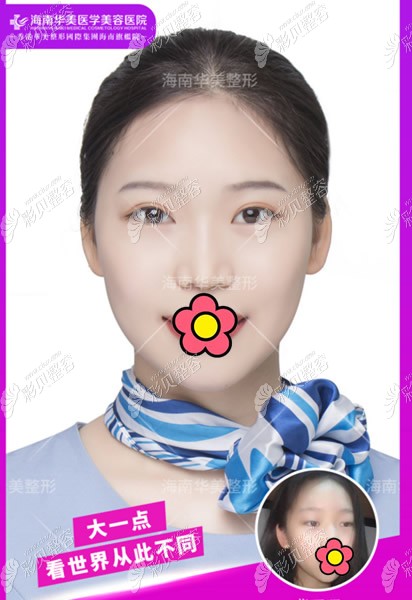 ?？谌A美趙曉蘭醫(yī)生割雙眼皮案例