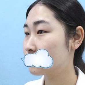 廈門海峽整形做雙眼皮找張宏，看過案例的人都說好！