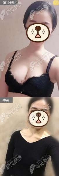 去汕頭華美做曼托假體隆胸術(shù)前術(shù)后對比圖 去汕頭華美做曼托假體隆胸術(shù)前術(shù)后對比圖