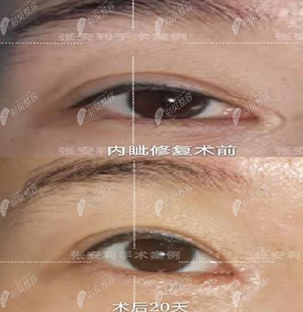 張安利醫(yī)生內(nèi)眥修復(fù)前后對比照片