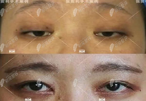 張安利重度上瞼下垂修復(fù)案例圖