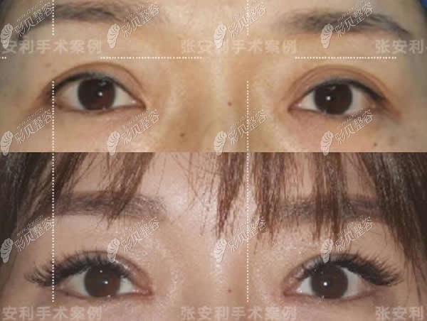 美萊整形張安利寬雙眼皮修復(fù)效果