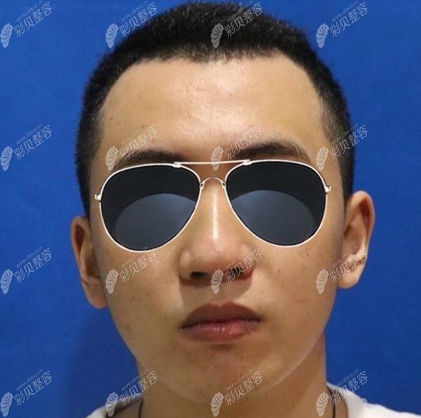 武漢亞韓醫(yī)院鄧正輝做鼻子案例:醫(yī)生選對(duì)了,大叔也能變鮮肉