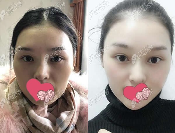 長沙貝美熊宜文醫(yī)生歪鼻矯正術(shù)前術(shù)后對比圖