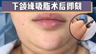 來1張烏魯木齊黎美整形許黎醫(yī)生面部下頜緣抽脂前后對比圖!