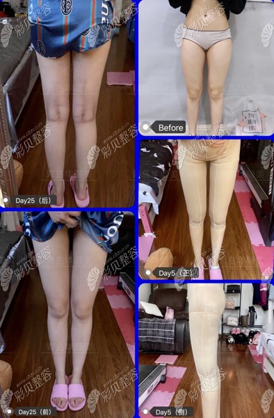 我大腿抽脂0天,5天,25天前后對(duì)比照片,大粗腿也能變成直腿精