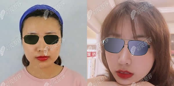 華韓華美整形孫玥玥醫(yī)生鼻修復(fù)前后對比圖 華韓華美整形孫玥玥醫(yī)生鼻修復(fù)前后對比圖