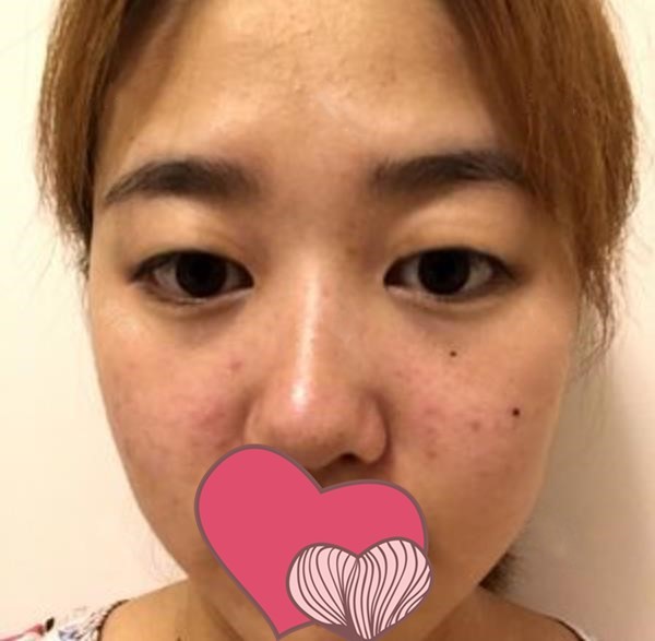 吉林星范楊雯淇醫(yī)生割完雙眼皮1-3天案例圖反饋,膠布還沒拆