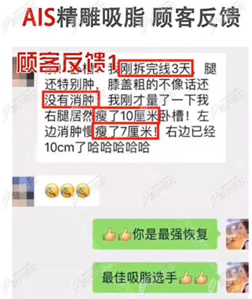 成都艾米麗醫(yī)院ais腰腹環(huán)吸效果視頻:術前腰圍93cm術后75厘米