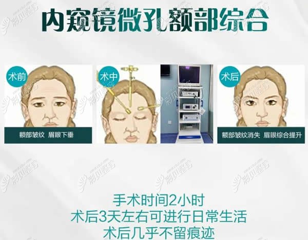 王洪內(nèi)窺鏡微孔額部綜合提升手術(shù)過程 王洪內(nèi)窺鏡微孔額部綜合提升手術(shù)過程