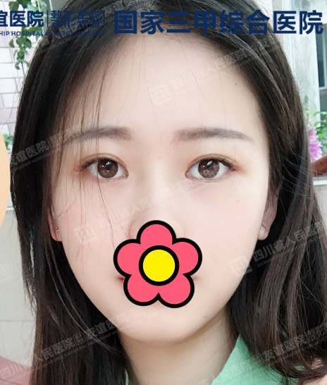 四川張立天醫(yī)生面部輪廓四件套案列:重點(diǎn)看顴骨下頜角部位
