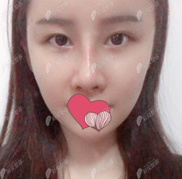 肋軟骨隆鼻術后3個月比1個月更自然