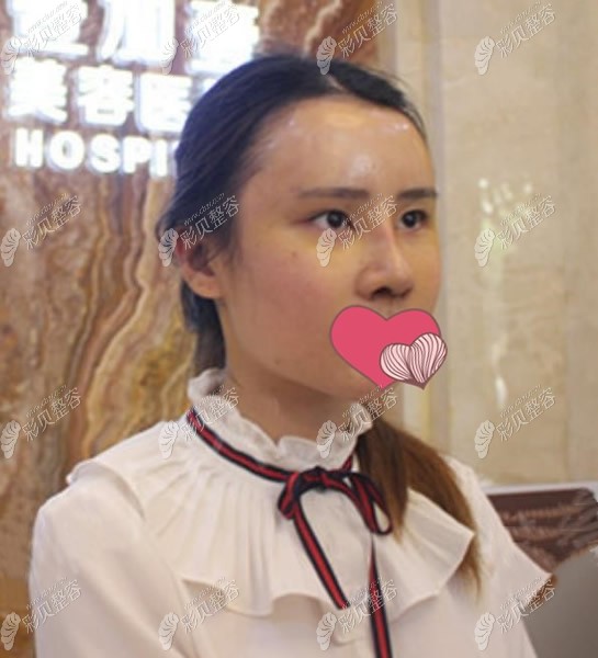蕪湖壹加壹肋骨鼻綜合7天拆線圖