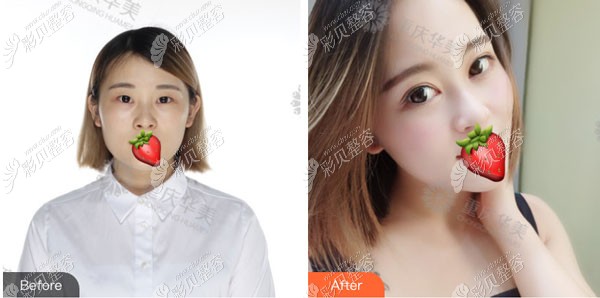 重慶華美李富強醫(yī)生baby精靈眼綜合是咋做出來的,效果怎么樣