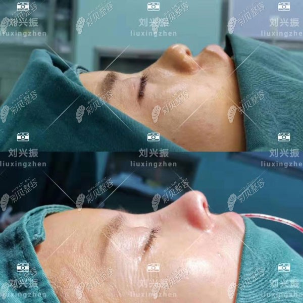 劉興振剛做完鼻綜合對比 劉興振剛做完鼻綜合對比