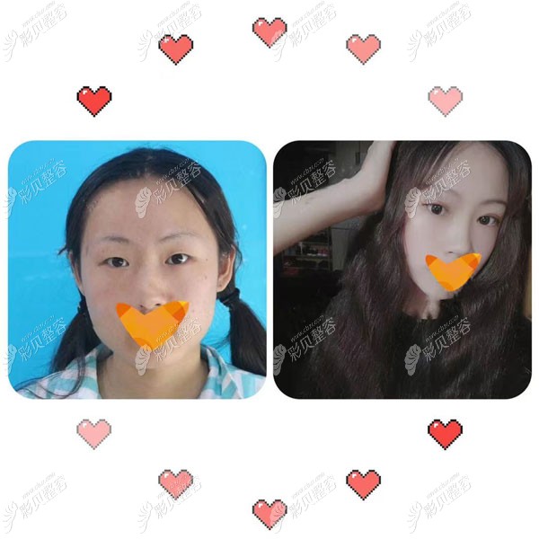 來(lái)青島華顏美醫(yī)院找武偉亮院長(zhǎng)做了雙眼皮就沒(méi)有后悔過(guò)
