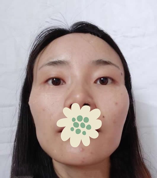 在北京藝星做自體脂肪面部填充20天后，突出的顴骨不高了