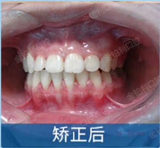 成年人地包天+牙齒擁擠矯正前后對(duì)比照,嘉興金鉑利口腔做的