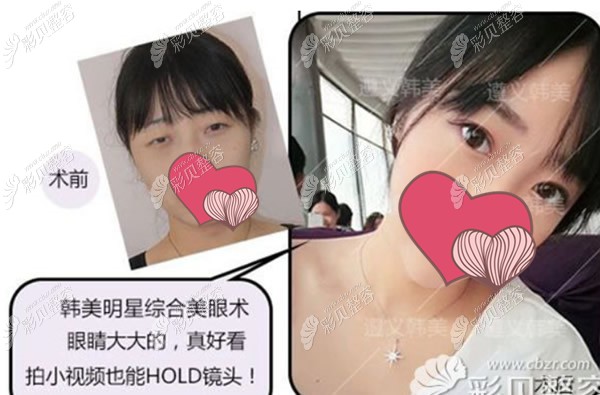 遵義韓美眼綜合整形前后效果對比照片