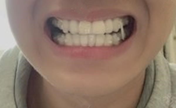 成人戴隱適美牙套矯正齙牙前后對比照，20歲矯正牙齒并不晚
