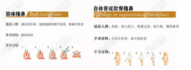 廈門欣醫(yī)美李攀醫(yī)生隆鼻 廈門欣醫(yī)美李攀醫(yī)生隆鼻