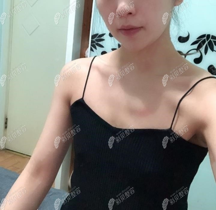 平胸女去重慶華美做曼托235CC假體隆胸恢復后，大小有C罩杯