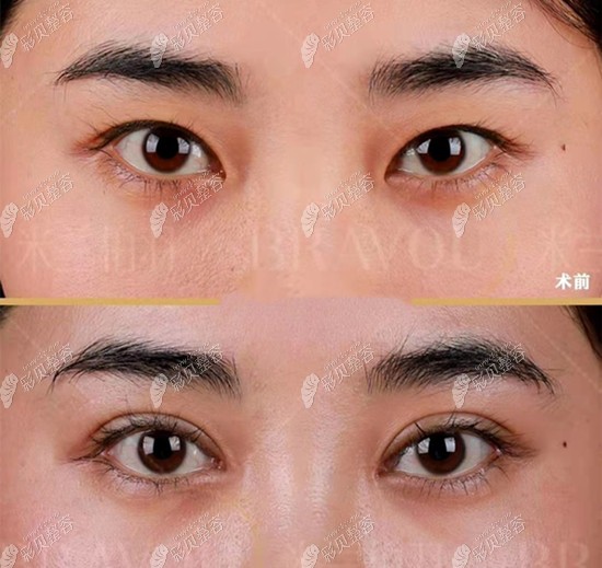 西安米蘭柏羽張筠莉割雙眼皮效果圖 西安米蘭柏羽張筠莉割雙眼皮效果圖