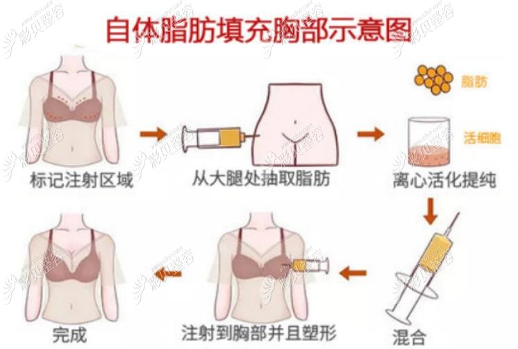 自體脂肪豐胸過程圖 自體脂肪豐胸過程圖