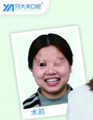 長沙牙大夫周權(quán)醫(yī)生正畸做的如何?分享隱適美隱形矯正圖片