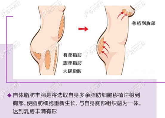廈門海峽自體脂肪豐胸原理 前后變化 廈門海峽自體脂肪豐胸原理 前后變化