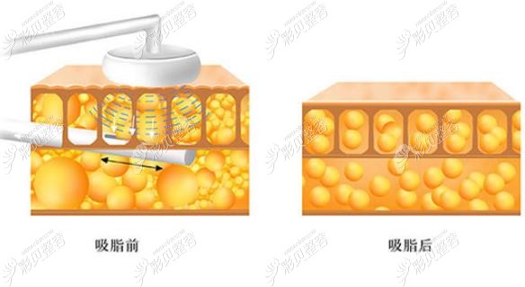 抽脂前后脂肪對比 抽脂前后脂肪對比