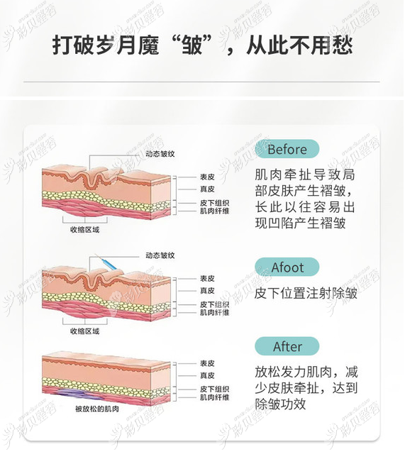 廣州美萊除皺功效 廣州美萊除皺功效