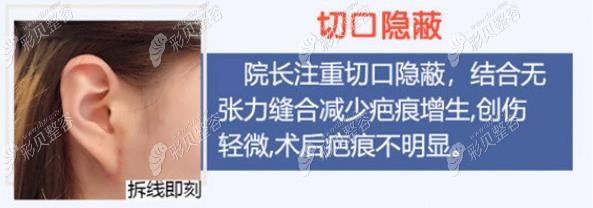 江蘇施爾美拉皮術(shù)后即刻拆線疤痕情況 江蘇施爾美拉皮術(shù)后即刻拆線疤痕情況