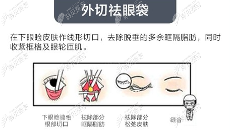 新疆華美外切祛眼袋 新疆華美外切祛眼袋