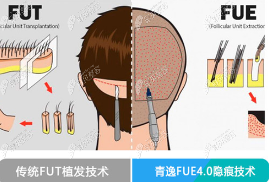青逸FUE4.0植發(fā)和傳統(tǒng)技術(shù)對(duì)比