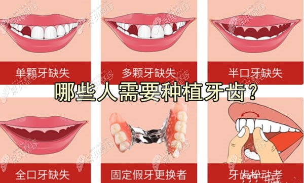 哪些人需要做種植牙