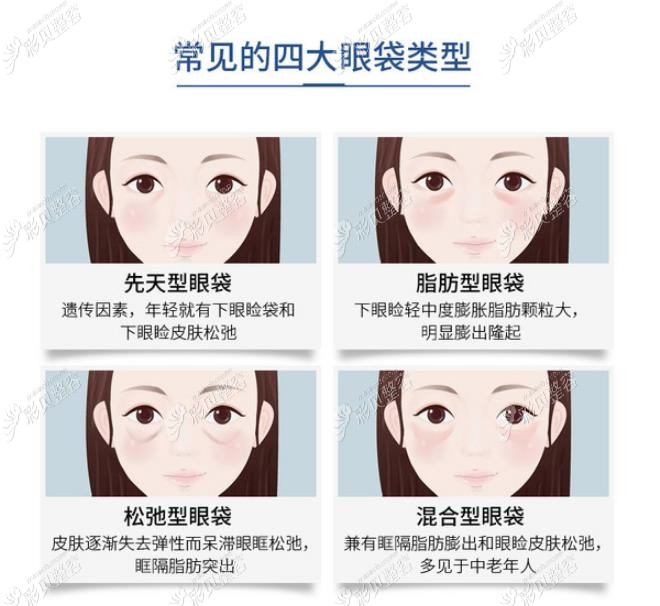 眼袋的不同類型 眼袋的不同類型